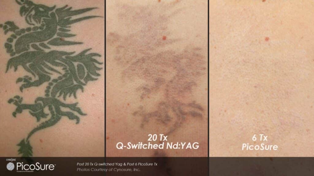 tattoo removal lethbridge