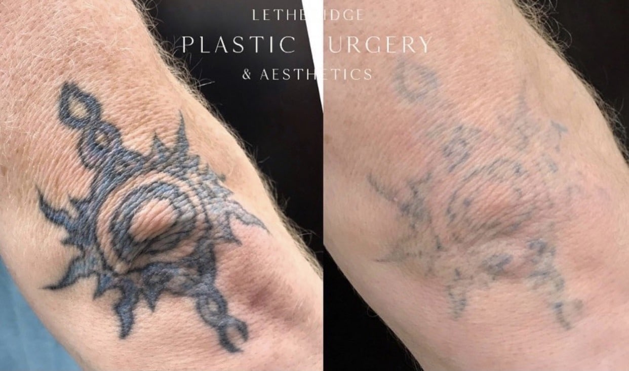 Laser Tattoo Removal in Lethbridge