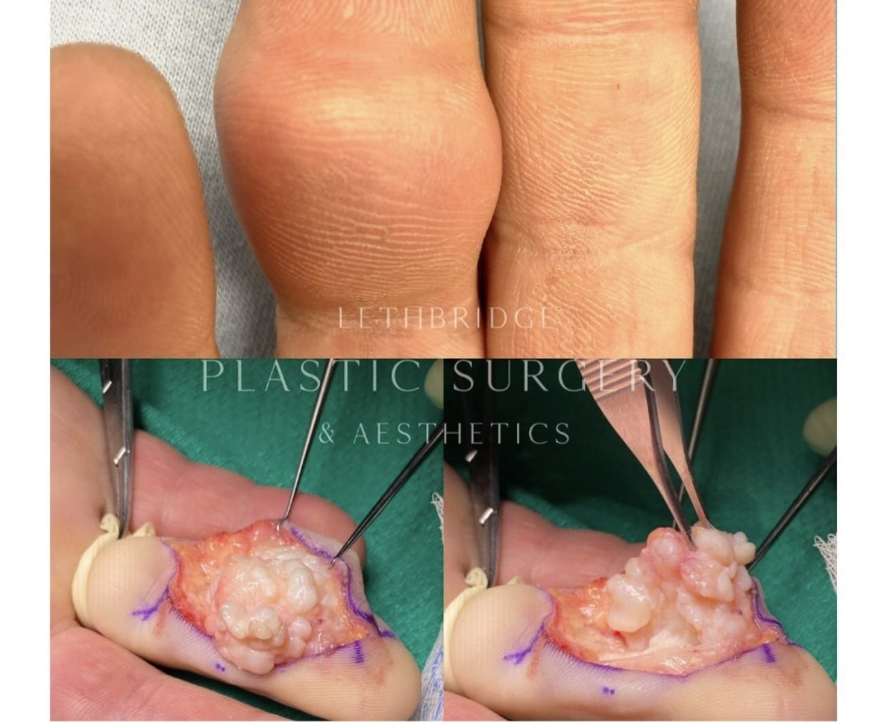Dupuytren's Contracture