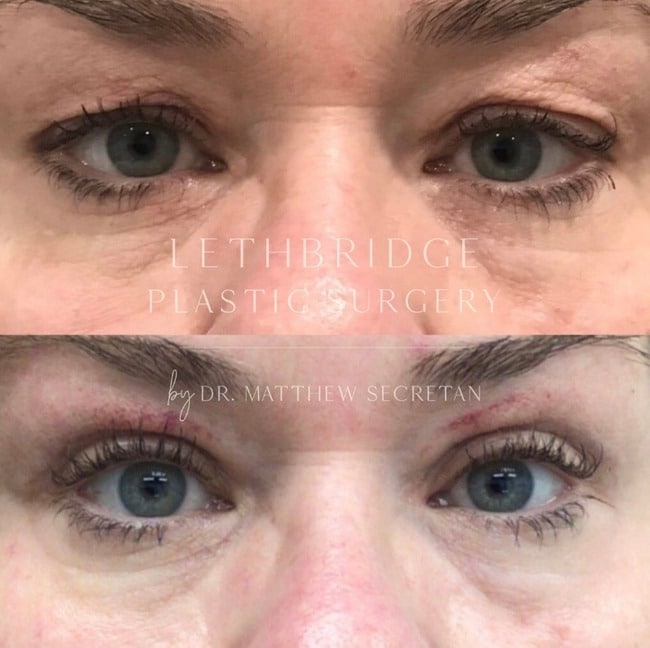 Upper Blepharoplasty in Lethbridge by Dr Secretan