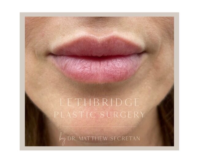 Lip Injections in Lethbridge, Alberta