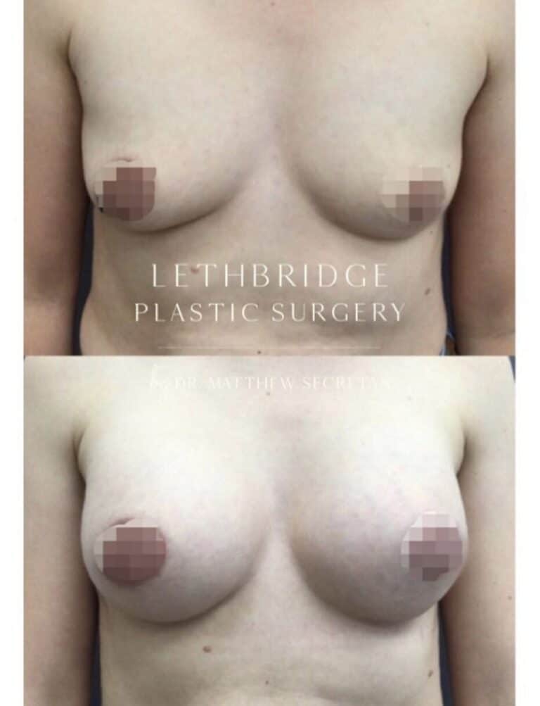 Breast Augmentation in Lethbridge
