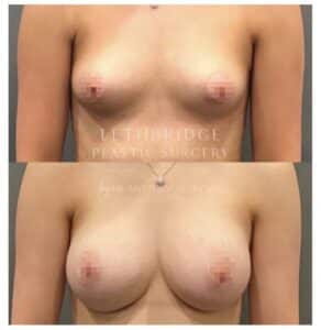 breast implants by Dr. Secretan in Lethbridge breast implants by Dr. Secretan in Lethbridge