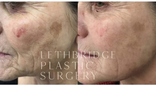 Skin Health at Lethbridge Plastic Surgery & Aesthetics Before and After of skin health on female patient