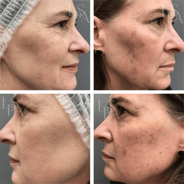 Skin Health at Lethbridge Plastic Surgery and Aesthetics Before & After of skin health on female patient