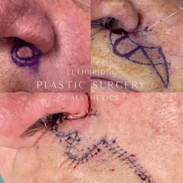 Basal Cell Carcinoma