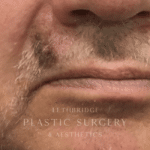 Melanoma reconstructive surgery in Alberta