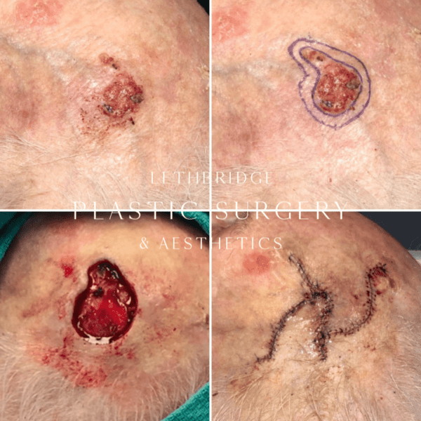 Squamous Cell Carcinoma
