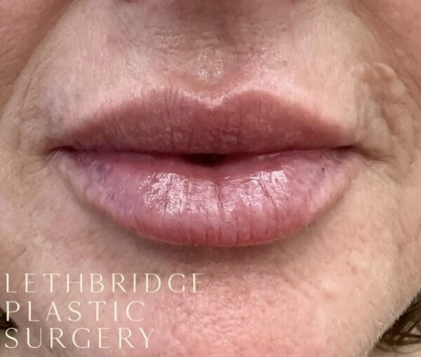 913FA3CF 0F98 43BA AB19 D7096E917A22 Will My Lips Look Normal After Receiving Lip Filler