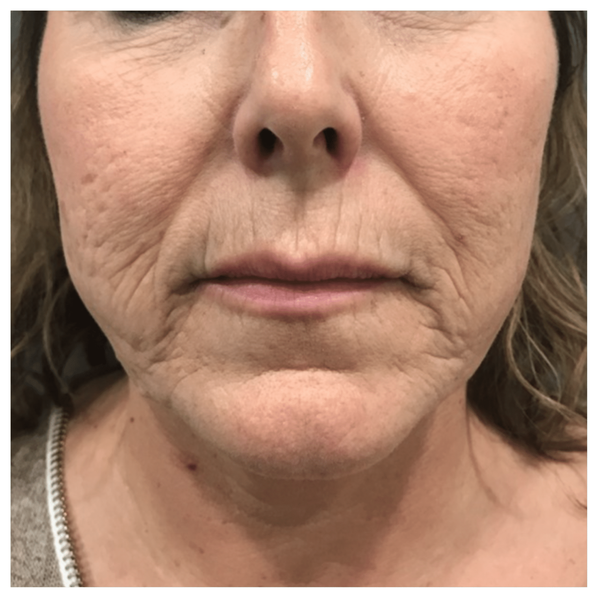 skin rejuvenation aging skin