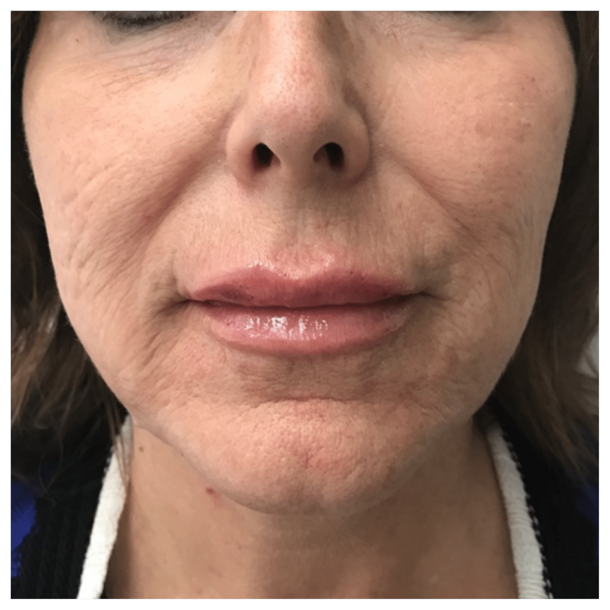 skin rejuvenation aging skin