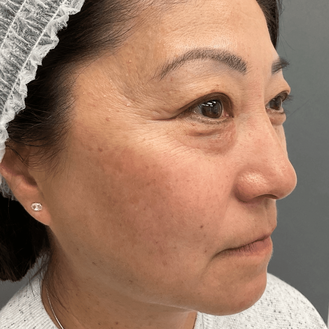 hyperpigmentation results sunspot removal