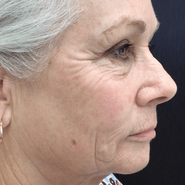 co2 laser rejuvenation Lethbridge medical spa