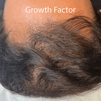 A man's receding hairline before his Growth Factor treatments