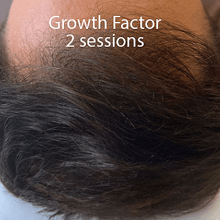 A man's hairline returning after two Growth Factor sessions