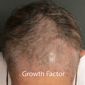 A man losing his hair before Growth Factor