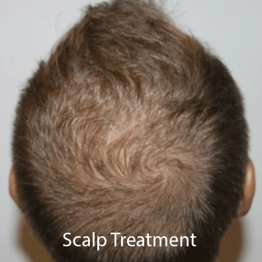 Bald spot forming on a man's head