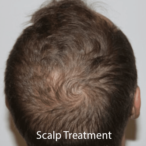 A man slowly getting a bald spot