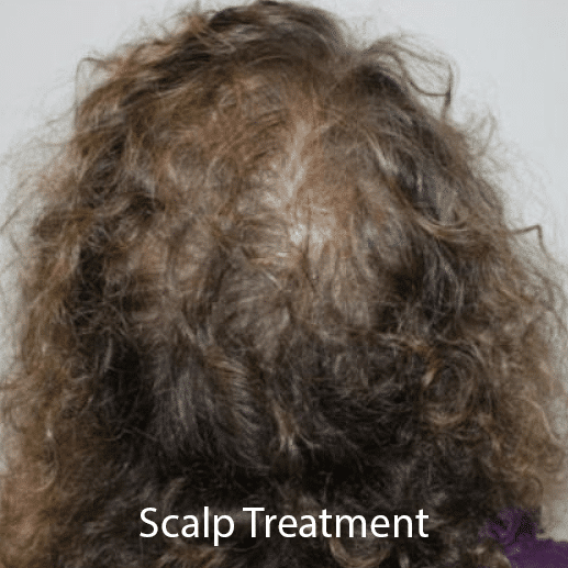 Thinning hair on a woman