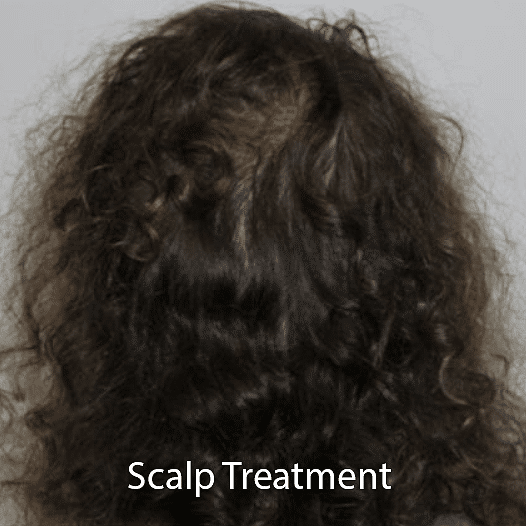 Thinning hair on a woman