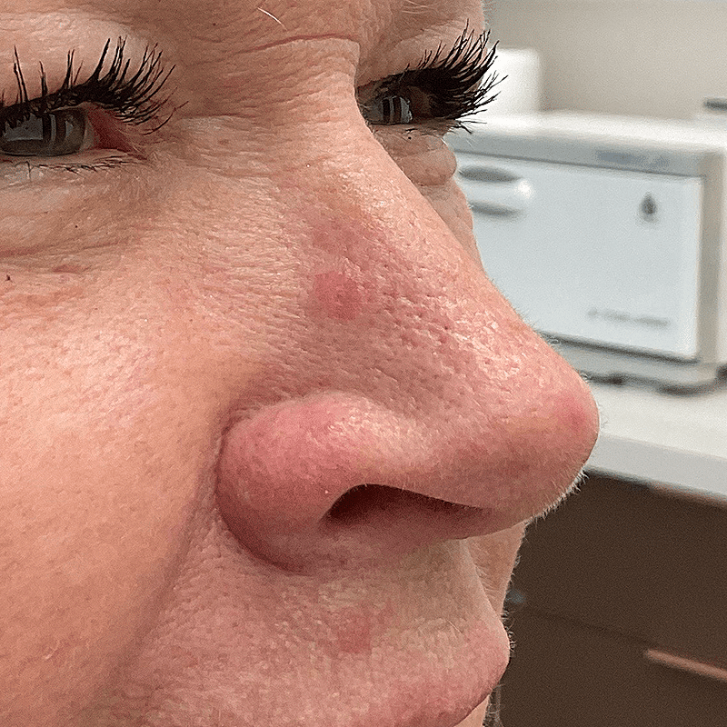 remove moles on your face with a laser