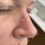 get rid of moles with laser in Lethbridge Alberta