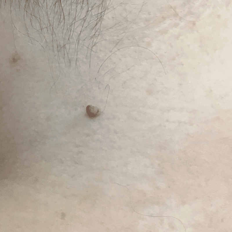 how to get rid of moles fast in southern Alberta