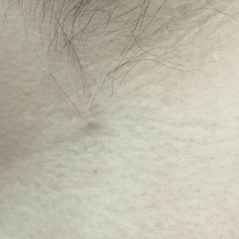 you can get rid of moles fast in southern Alberta