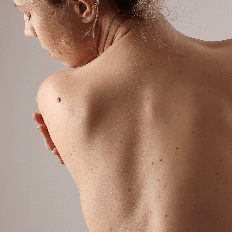 cos laser mole removal in southern alberta
