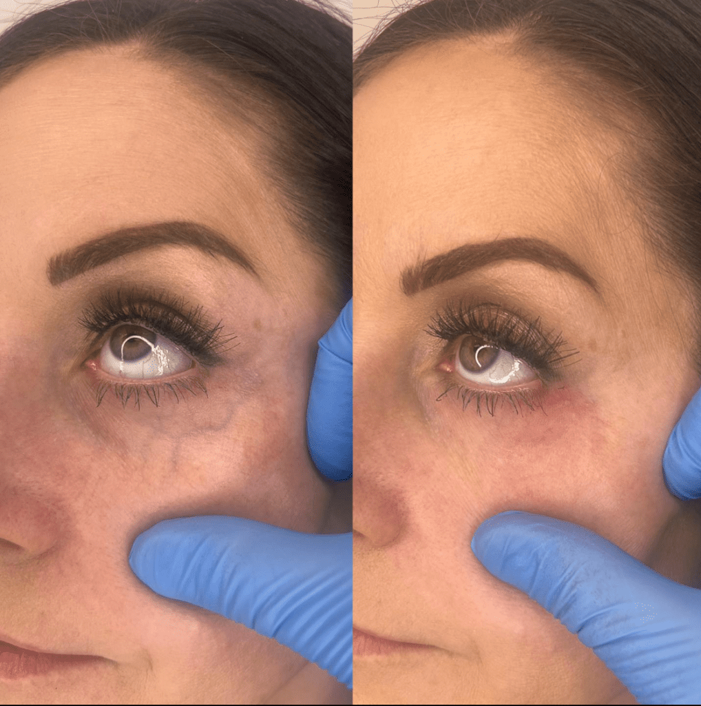 A before and after look at a woman who underwent eye vein treatment